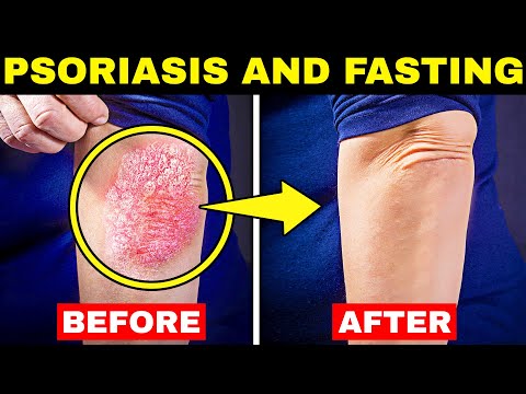 New Study! Psoriasis Treatment and Intermittent Fasting