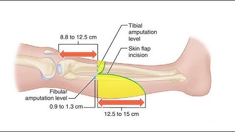 Transtibial- Below Knee- Amputation for the Ischemic Limbs