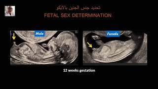 تحديد جنس الجنين بالايكو      fetal sex determination