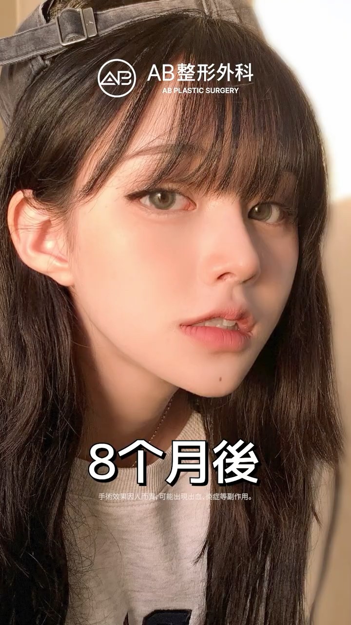 韓國 面部轮廓三件套＋隆鼻整形回自信！#Shorts