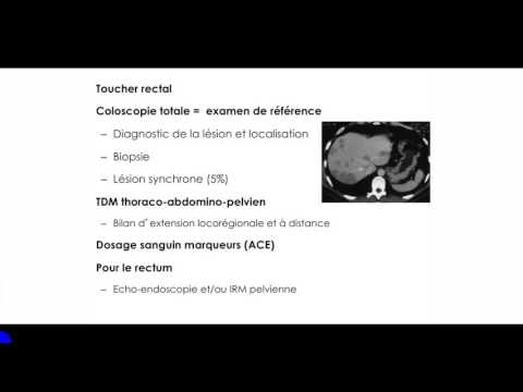 Vidéo: Une Numération Plaquettaire élevée Est Un Marqueur Prédictif Et Pronostique Négatif Dans Le Cancer Rectal Localement Avancé Subissant Une Chimioradiothérapie Néoadjuvante: Une étud