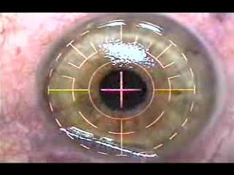young-woman-undergoes-lasik-to-correct-near-sightedness