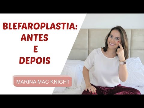 Vídeo: Blefaroplastia - Indicações, Contra-indicações, Revisões, Antes E Depois