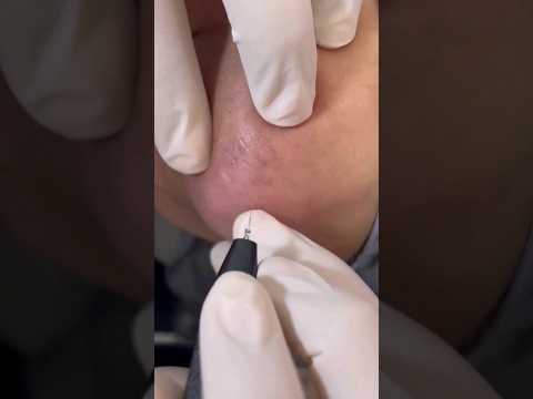 التخلص من الشعر الابيض للابد الحل الجذري