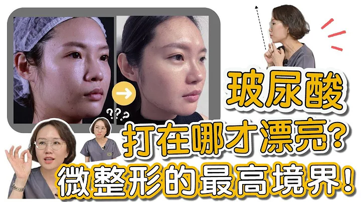你是六角臉嗎？太陽穴凹陷、顴骨高，顯老又高冷，讓莊盈彥醫師用玻尿酸打造你的高級臉！ - 天天要聞