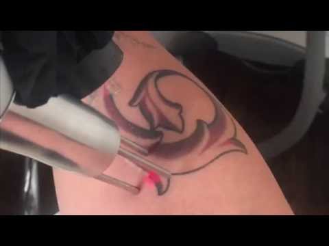 Evolve Tattoo Removal - First Laser Treatment
