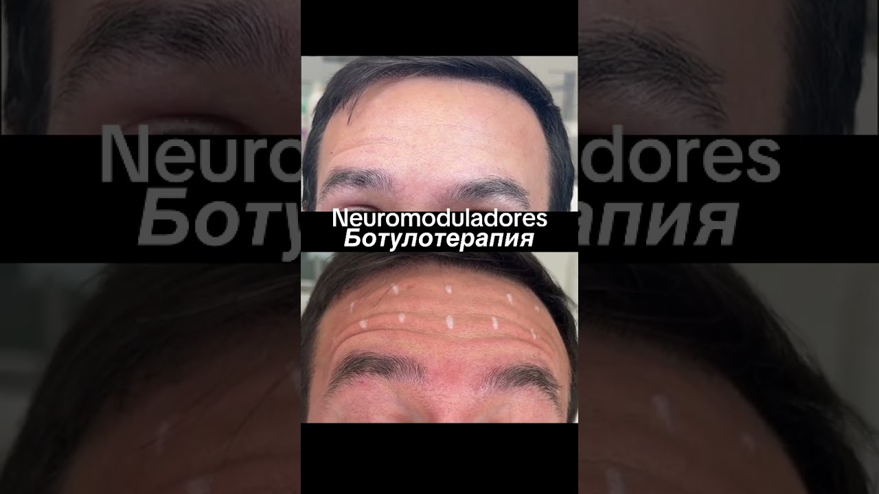 Arrugas en la frente entrecejo, patas de gallo Морщины на лбу, межбровка, вокруг глаз, гусиные лапки