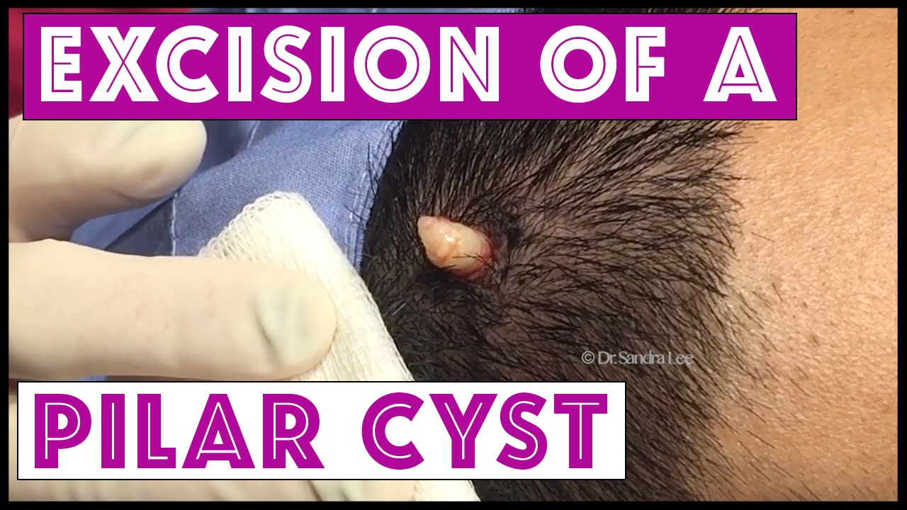 Pilar Cysts : Causes, Pictures, Symptoms and Treatment