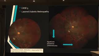 AIOC2026   IC69   T Prof Gopal S  Pillai How ultra widefield imaging is shifting diagnosis toward pe