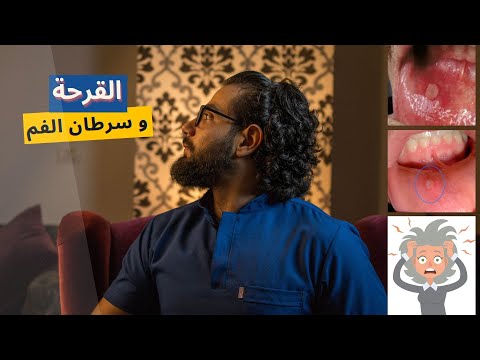 فيديو: 3 طرق لعلاج سرطان الفم