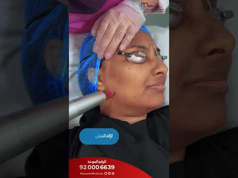 جهاز البيكو واي لإزالة النمش والتصبغات