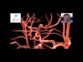 stent assisted coiling of cerebral  aneurysm