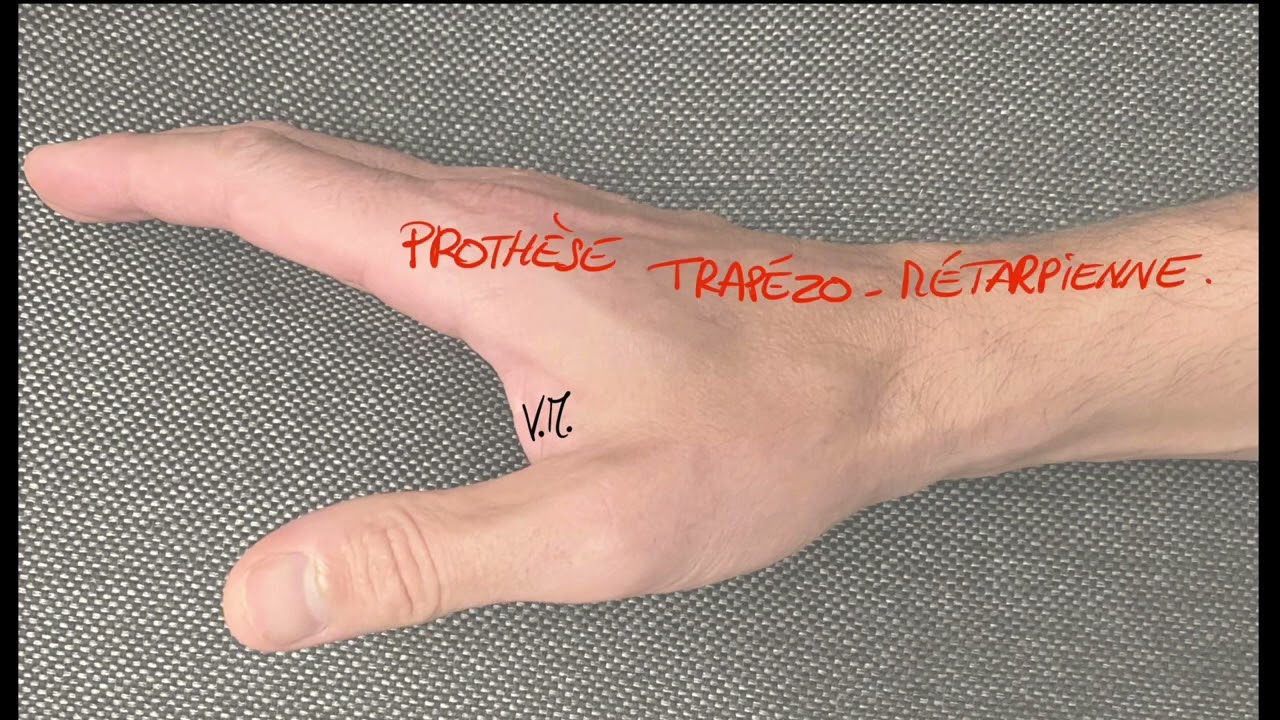 C’est quoi une prothèse trapézo métacarpienne?