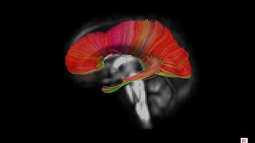 DTI of the human corpus callosum (CC)