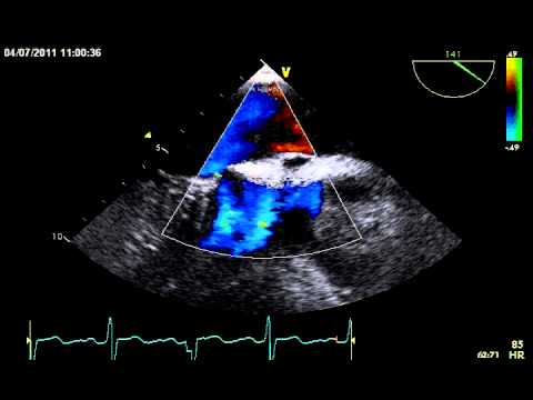 Video: Ukosefu Wa Moyo Wa Kuzaliwa (Upungufu Wa Atrial Septal) Katika Mbwa