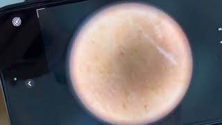 Skin! Oh skin! The  best eyes for exploring  skin conditions, dermatoscope.