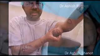 Multiple Lipoma  Treatment शरीर में चर्बी की गांठ का घरेलू उपाय | Home Remedies To Cure Lipoma