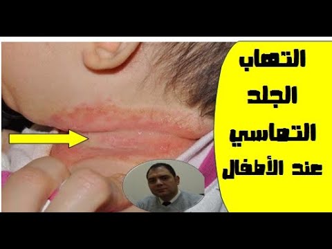 التهاب الجلدي التماسي عند الاطفال