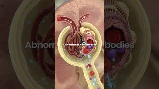 FDA just approved a treatment for IgA Nephropathy that works totally differently