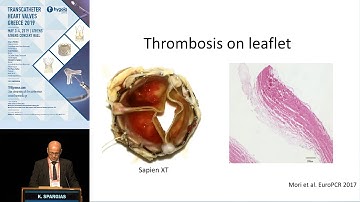 K. Spargias | Supra-annular TAVR devices. The real and possible advantages and disadvantages