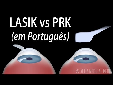 Vídeo: Diferença Entre Lasik E Lasek