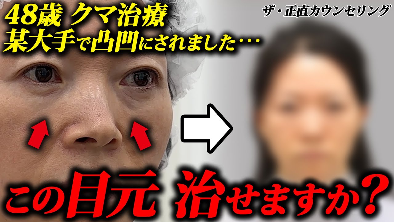 【クマ取り失敗】某大手のクマ取り治療で目の下が凸凹に。再治療で改善します