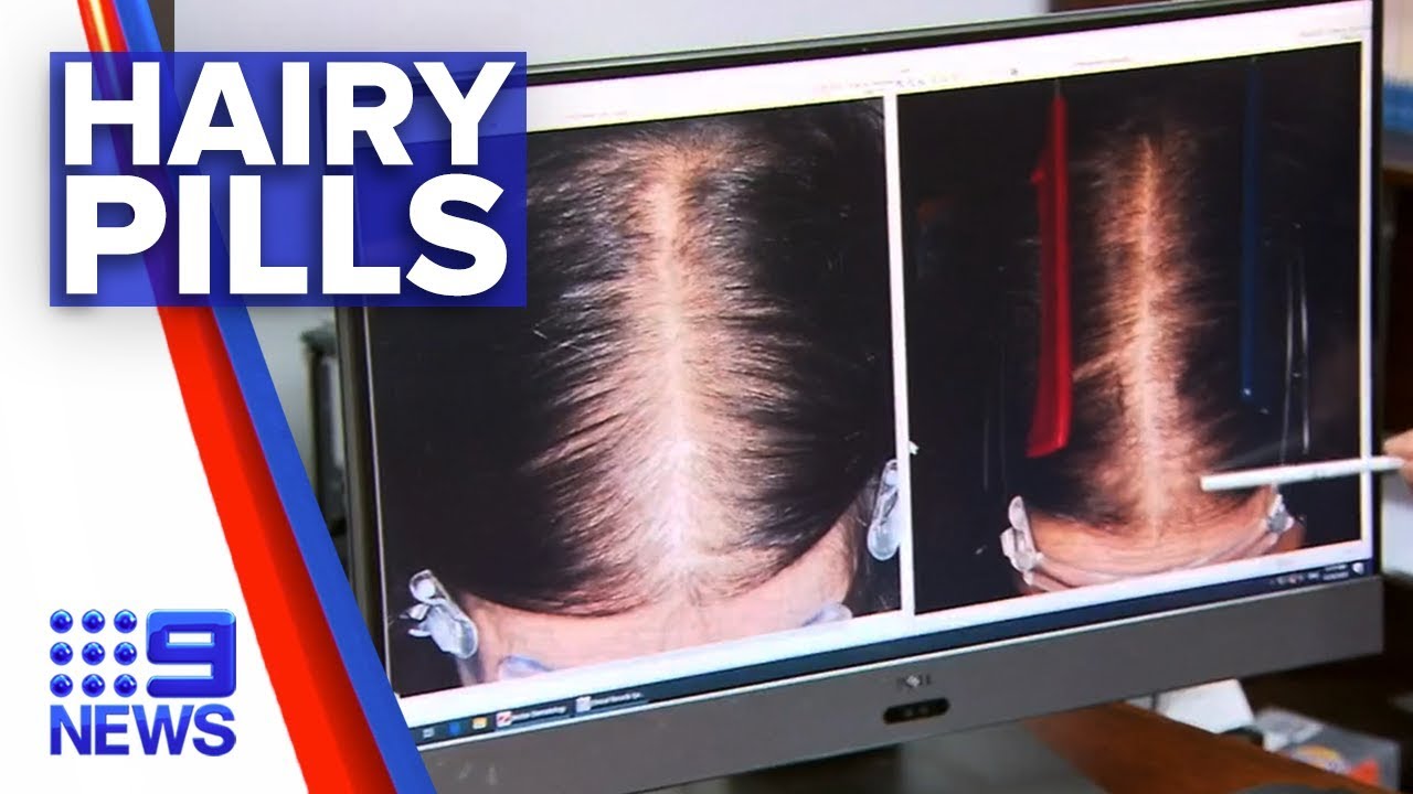 New pill to treat hair loss Nine News Australia YouTube