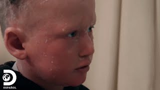 Una rara condición dermatológica afecta a un niño | Mi Cuerpo, Mi Desafío | Discovery en español