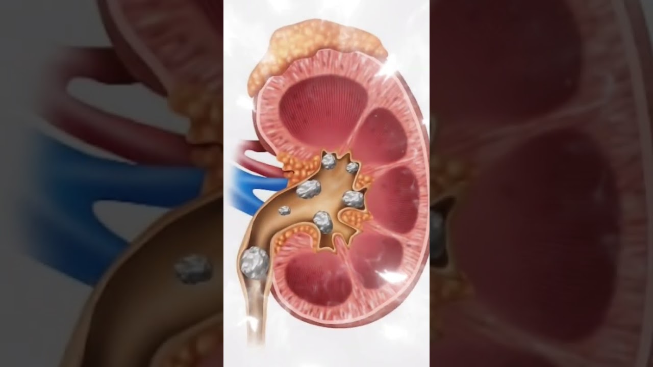 kidney Stone Pain killer Tablet 