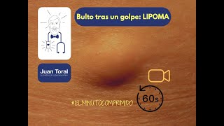 Por Qué Aparecen Bultos Tras Darnos Un Pe. Lipoma 𝔼𝕝 𝕄𝕚𝕟𝕦𝕥𝕠 ℂ𝕠𝕞𝕡𝕣𝕚𝕞𝕚𝕕𝕠 09