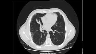 Appearance of normal chest CT with labels
