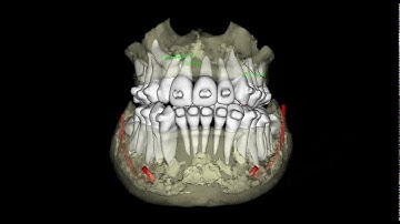 Invivo Anatomage 5 Impacted Canine Measurements