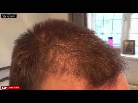Fue Hair Transplant Day 54 Post Op Recovery Youtube