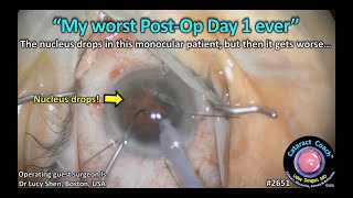 Cataractcoach 2651 My Worst Post-Op Day 1 Ever...