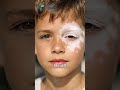 Halo nevus vitiligo skin पर क्या करता है surgery #shorts #vitiligo #safeddaag