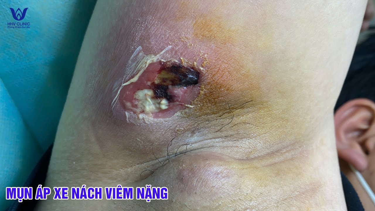 Nhọt mủ vùng nách nhiều người chủ quan và cái kết không ngờ.