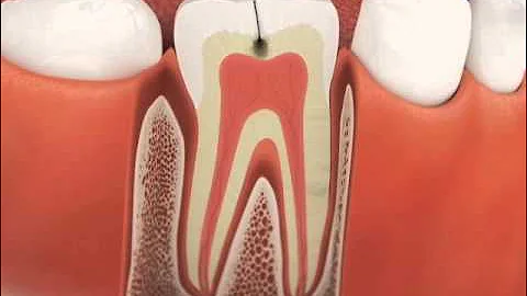 Why a Root Canal After a Crown - Sample CAESY Video