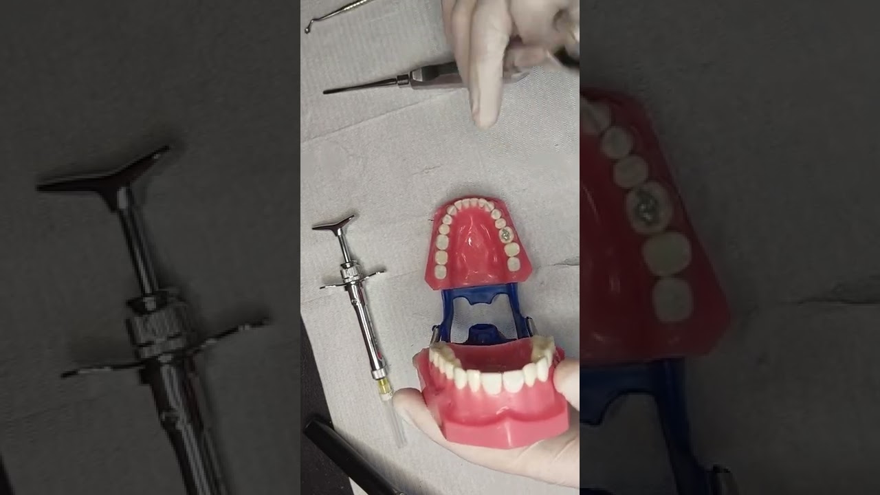 extracción de la pza incisivo lateral inferior