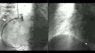 Coronary CT Angiography: Cath
