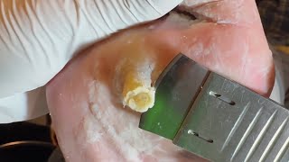 It is the first time I have seen such an absurd callus【Athlete’s foot pedicure】