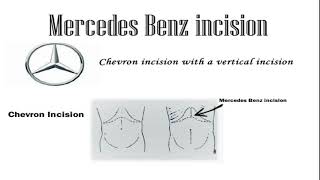 Chevron & Mercedes Benz Incision