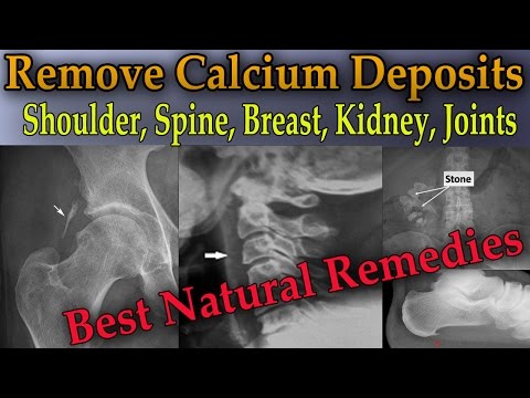 Remove Painful Calcium Deposits From Your Body (3 Best Home Remedies) - Dr Mandell