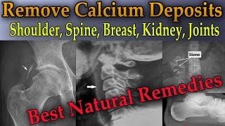 ⁣Remove Painful Calcium Deposits From Your Body (3 Best Home Remedies) - Dr Mandell