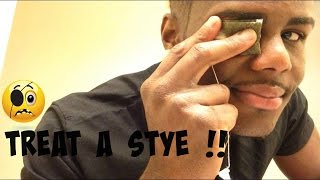 How To: treat a stye in your eye !! | Twhy Baby