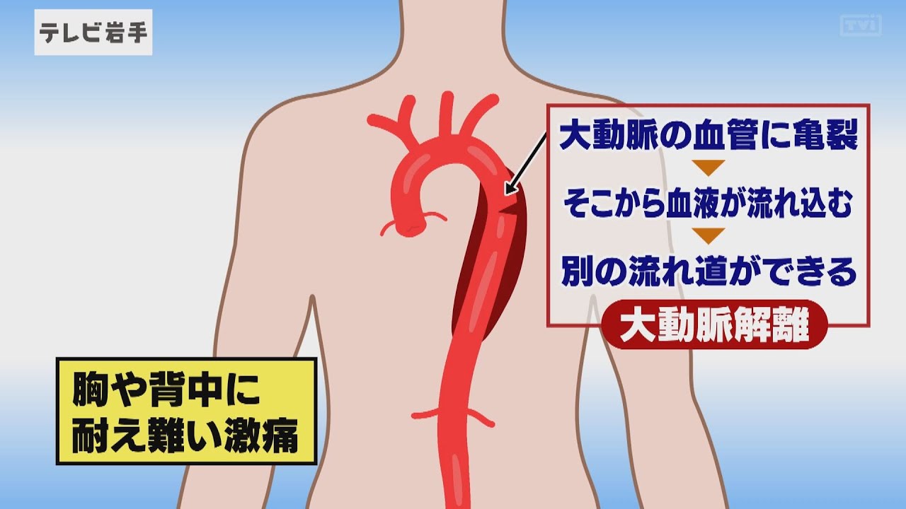 大動脈解離 リハビリ 禁忌 | 大動脈解離後のリハビリ – WLNM