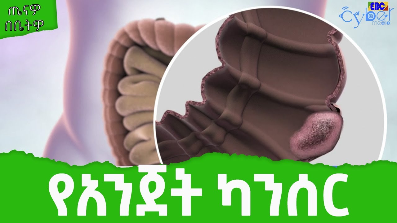 ጤናዎ በቤትዎ - የአንጀት ካንሰር  | Ethiopia | News
