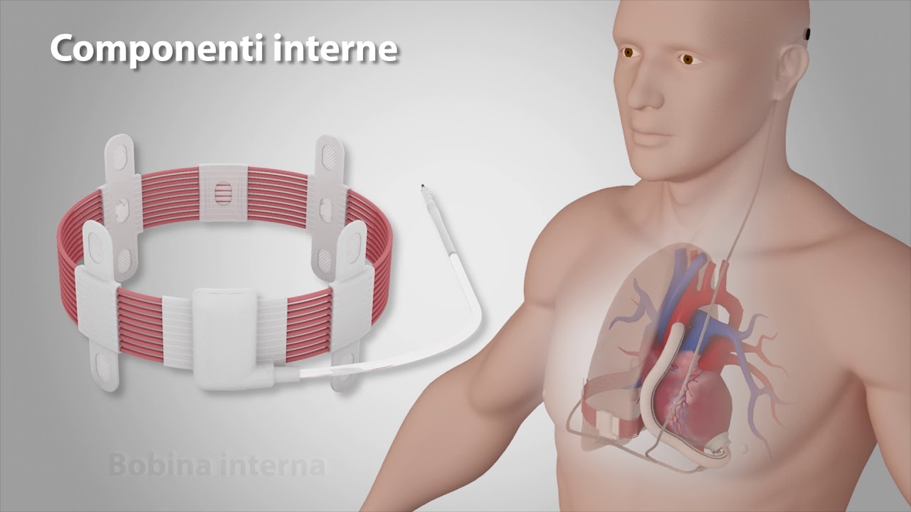 Come funziona il cuore wireless FIVAD di Leviticus Cardio (animazione italiano)