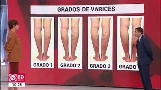 ¿Cómo se puede retrasar la aparición de las varices?