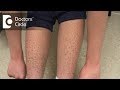 How to manage Ichthyosis Vulgaris in teenage boys? - Dr. Nischal K