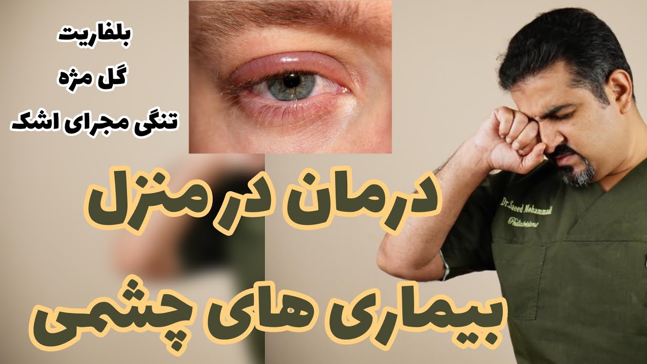 بلفاریت| گل مژه | تنگی مجرای اشکی | شالازیون| درمان در منزل بیماری های چشمی